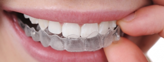 invisalign